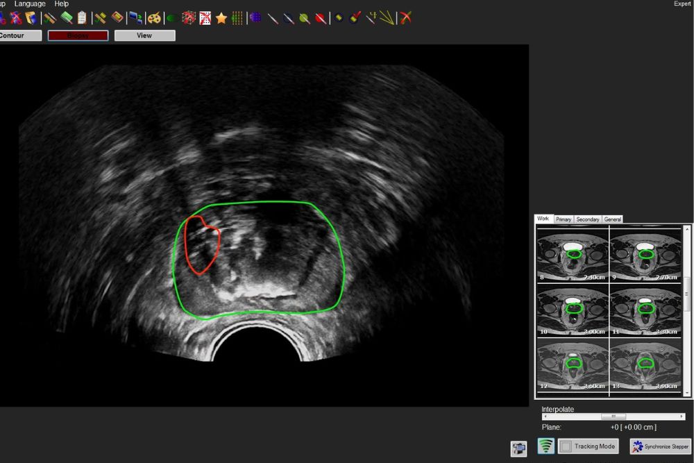 urologie-mainz-Fusionsbiopsie Fritsch 3